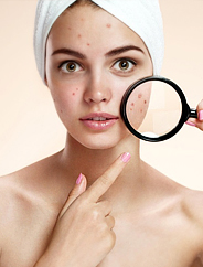 ACNE right banner
